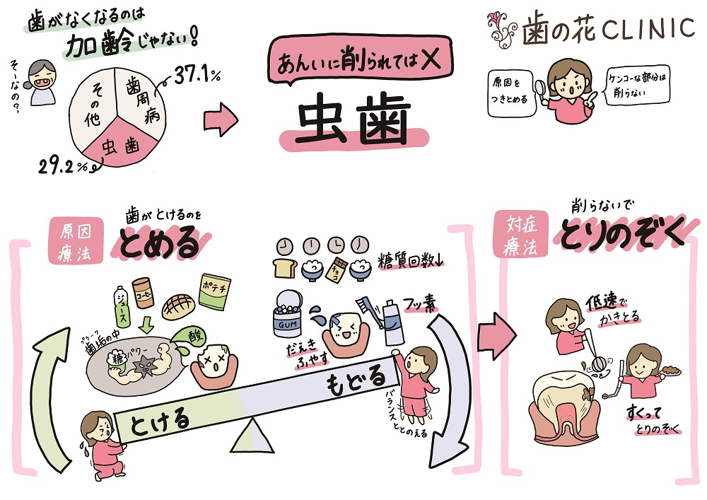 歯の花クリニックの虫歯治療