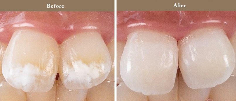 ホワイトスポット治療のビフォーアフター