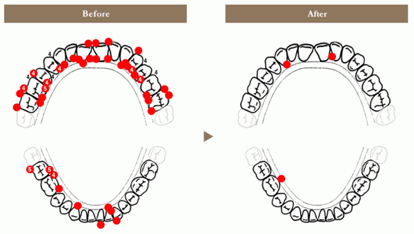 CASE①「2回の来院で、歯周病が劇的に改善」49歳・男性・医師​