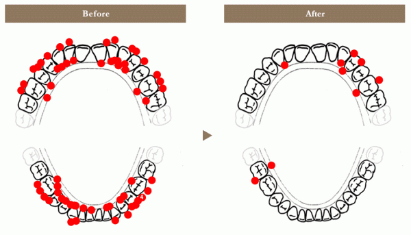 CASE②「“できない”と言われた矯正治療が叶った」56歳・女性