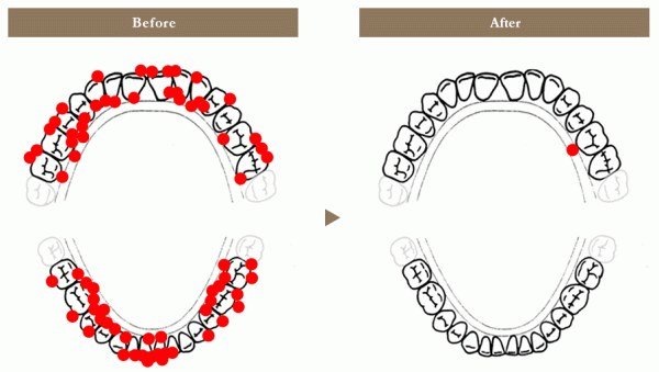 CASE③「歯を磨くといつも血が出る」26歳・女性